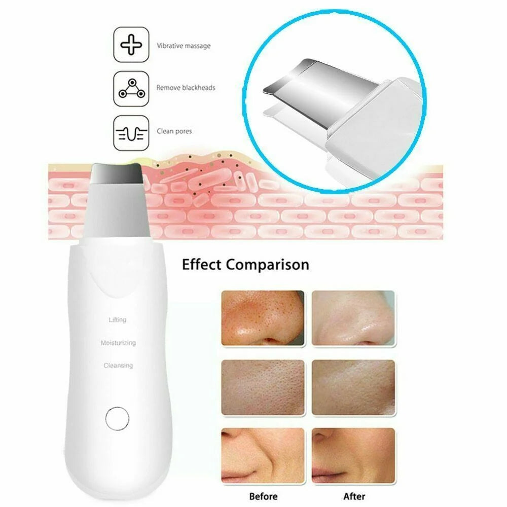 Ultrasonic Facial Skin Scrubber & Deep Pore Cleanser Spatula - AmaraKin Nursery & Family Essentials (Photo 4)